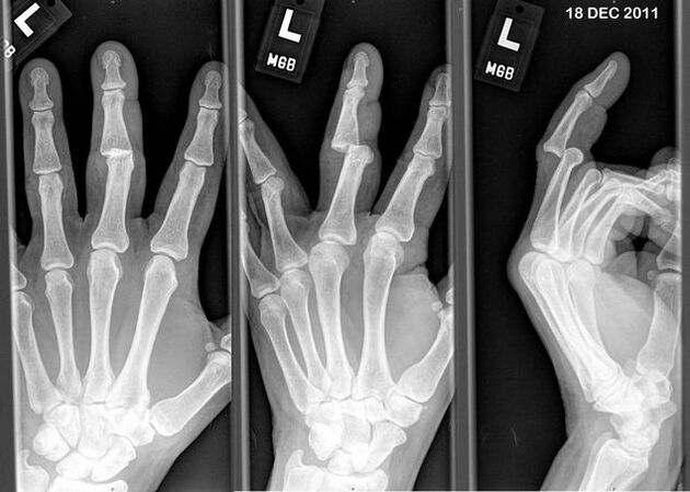 Nihestatud sõrmede röntgen