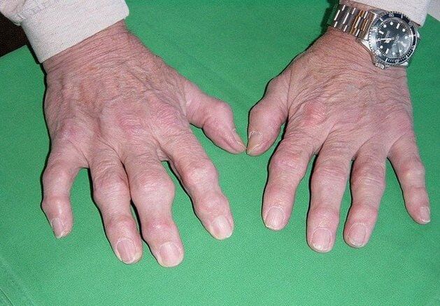 Sõrmede artroos