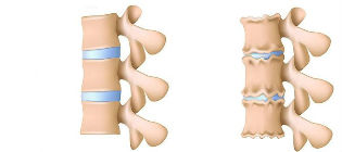 Osteokondroosi arengu mehhanism