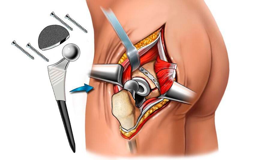 Endoproteesi paigaldamine - koksartroosi probleemi kirurgiline lahendus