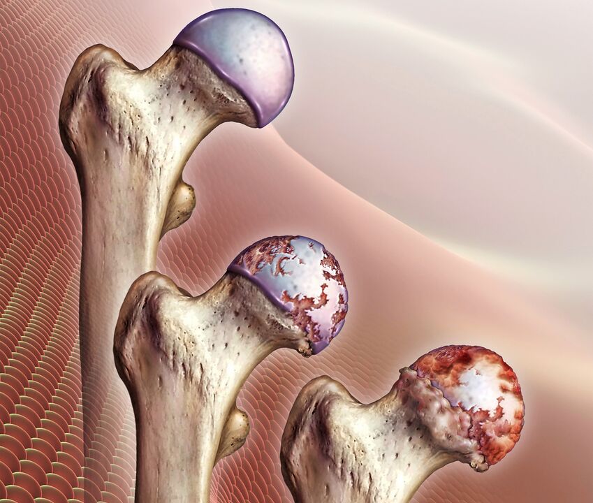 Puusaliigese artroosi areng