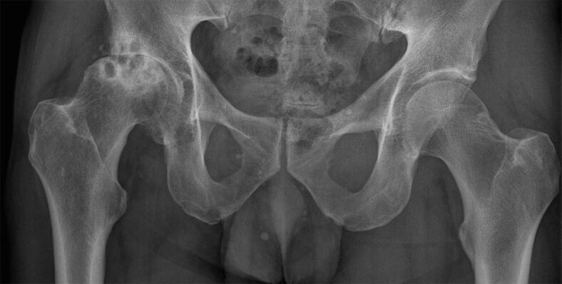 Puusaliigese deformeeriv artroos röntgenis