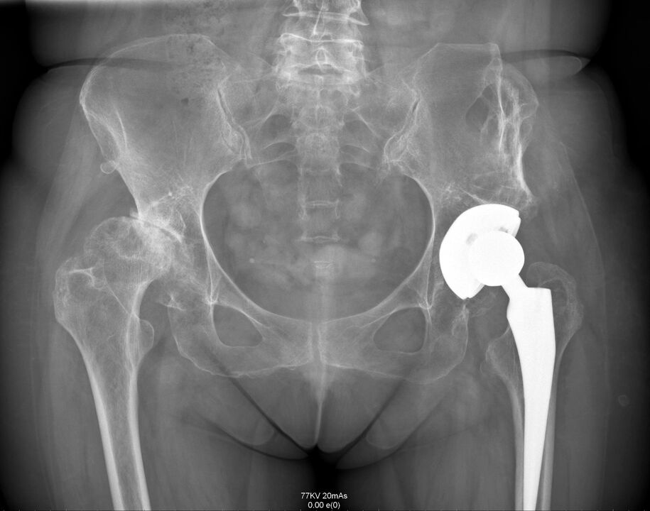 Puusaliigese röntgenuuring pärast artroplastikat