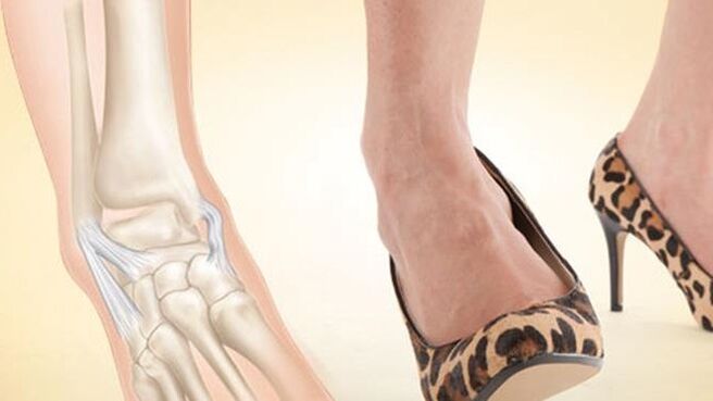 kontsaga kingade kandmine pahkluu artroosi põhjuseks