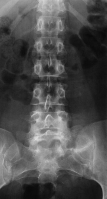 Nimmeosa osteokondroosi diagnoosimiseks tehakse radiograafia